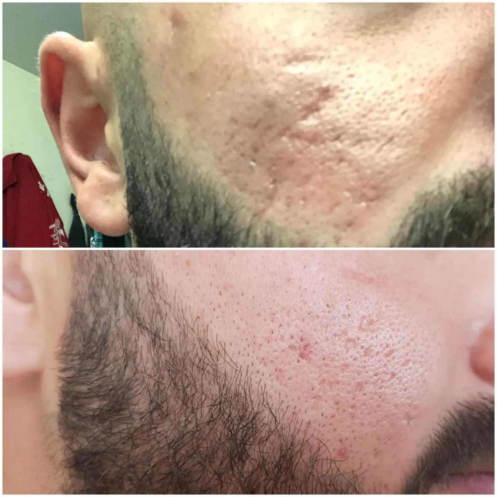 Ergebnis einer Plasma-Hautstraffung bei SmartBody Beauty in Leipzig – Bild 1