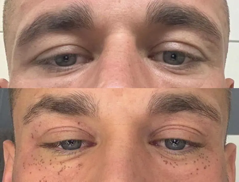 Ergebnis einer Plasma-Hautstraffung bei SmartBody Beauty in Leipzig – Bild 10 von 15