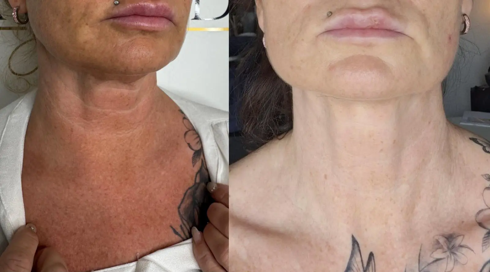 Ergebnis einer Plasma-Hautstraffung bei SmartBody Beauty in Leipzig – Bild 11 von 15