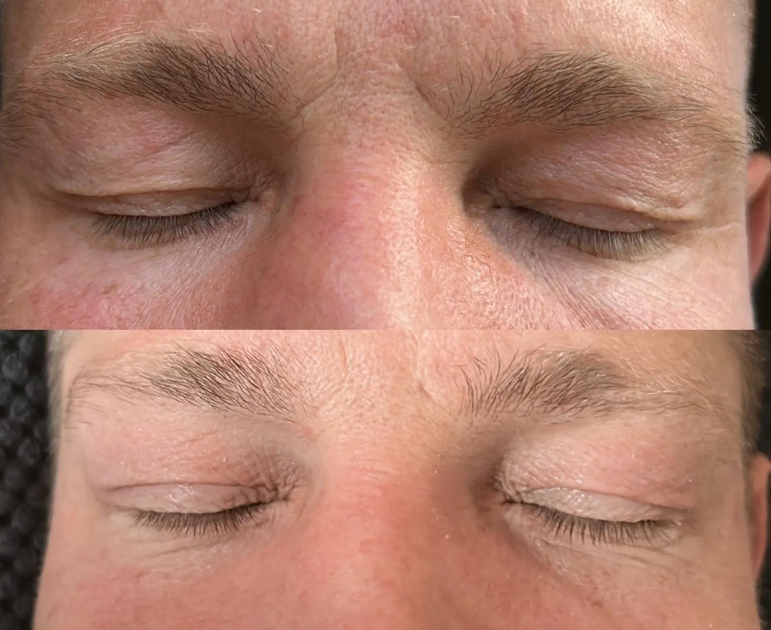 Ergebnis einer Plasma-Hautstraffung bei SmartBody Beauty in Leipzig – Bild 12 von 15