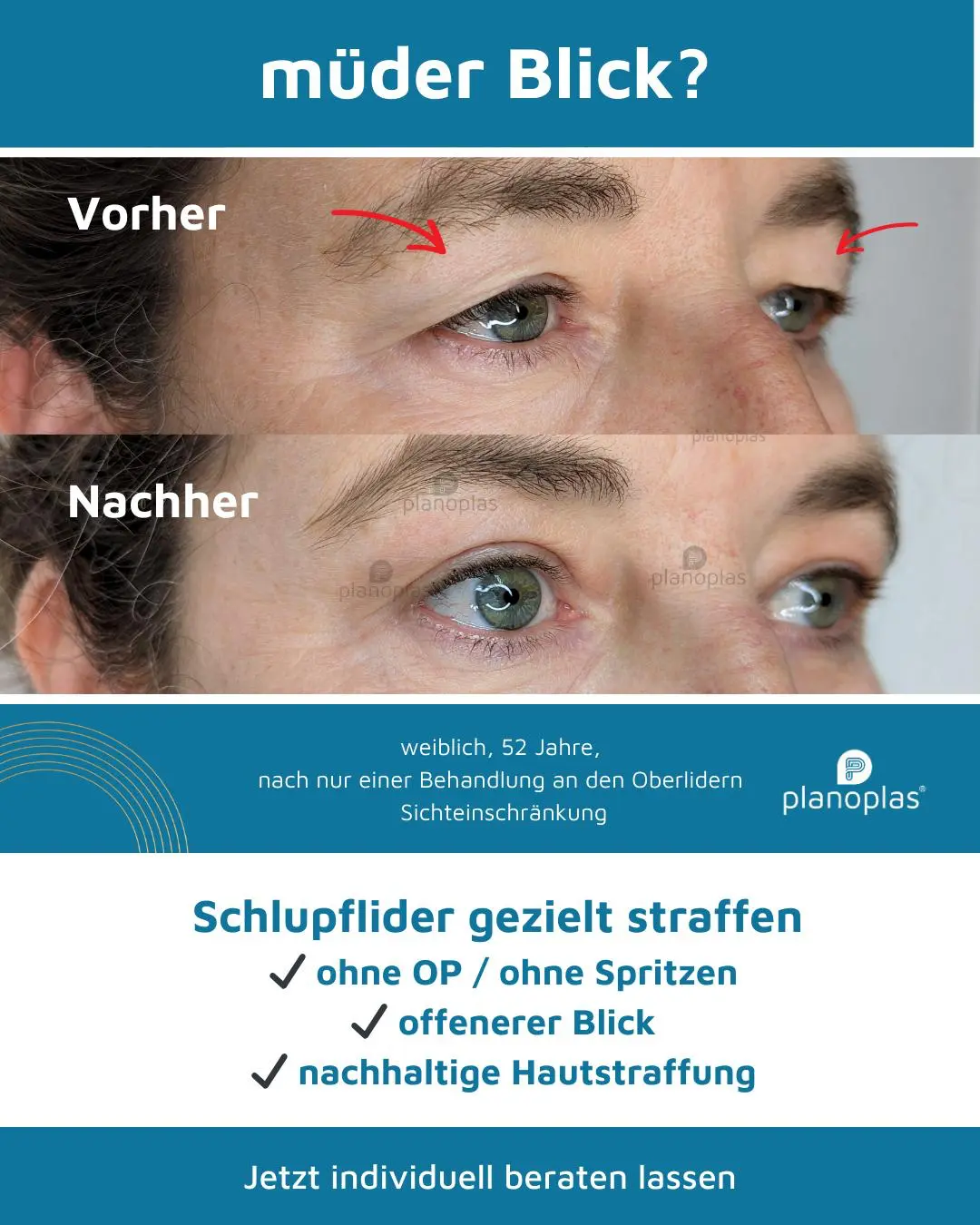Ergebnis einer Plasma-Hautstraffung bei SmartBody Beauty in Leipzig – Bild 4
