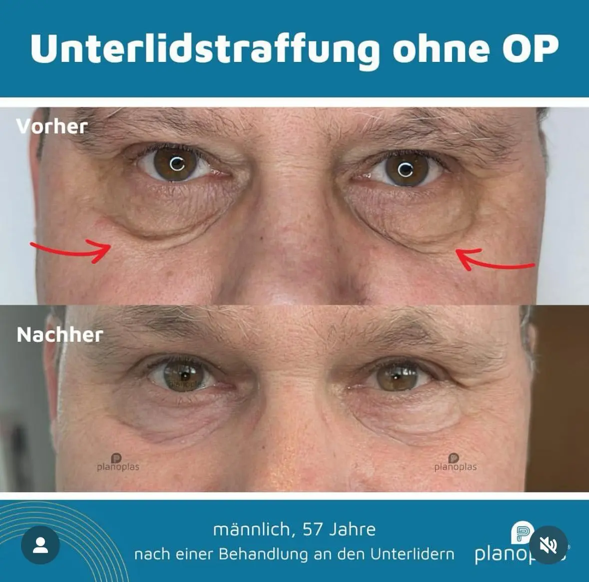 Ergebnis einer Plasma-Hautstraffung bei SmartBody Beauty in Leipzig – Bild 14 von 15
