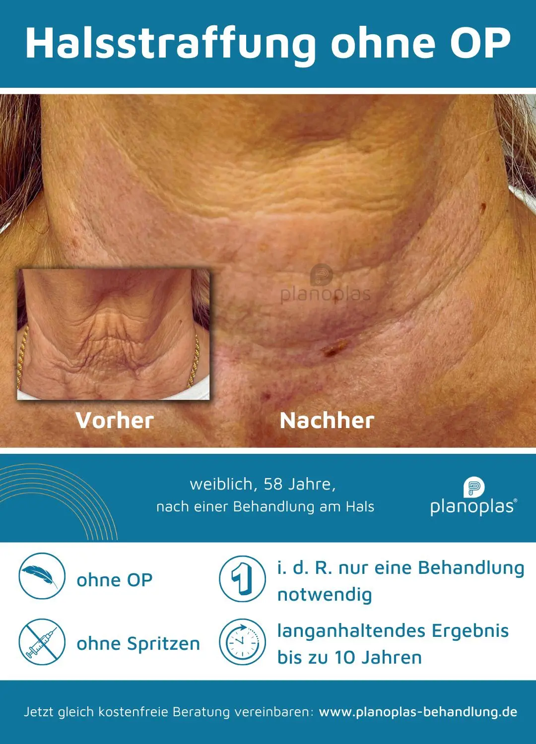 Ergebnis einer Plasma-Hautstraffung bei SmartBody Beauty in Leipzig – Bild 2 von 15