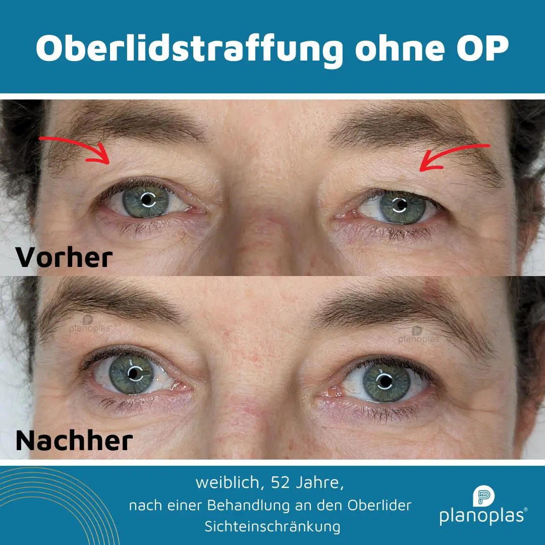 Ergebnis einer Plasma-Hautstraffung bei SmartBody Beauty in Leipzig – Bild 3 von 15