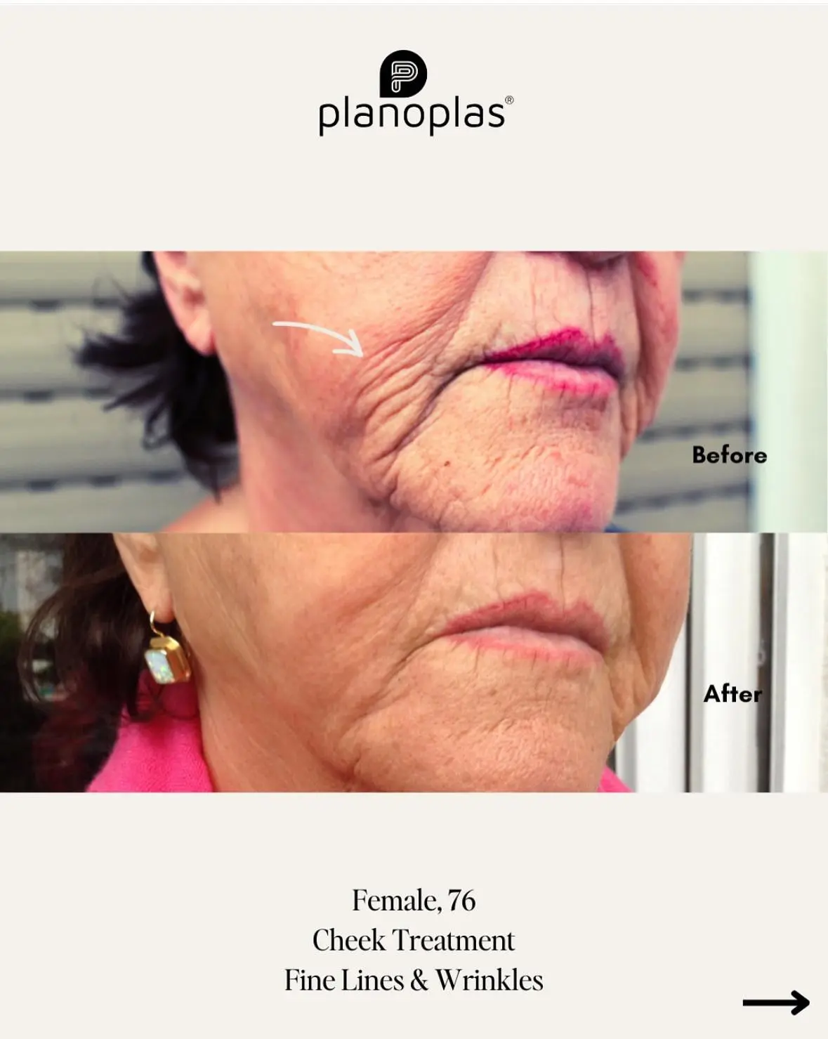 Ergebnis einer Plasma-Hautstraffung bei SmartBody Beauty in Leipzig – Bild 4 von 15