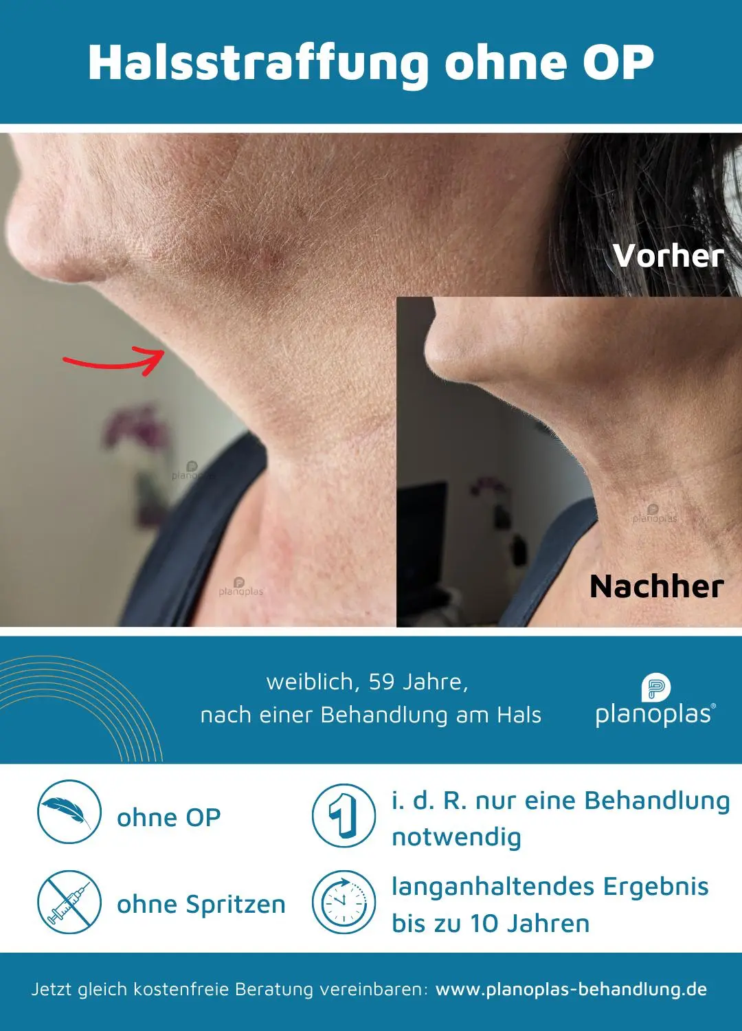 Ergebnis einer Plasma-Hautstraffung bei SmartBody Beauty in Leipzig – Bild 6 von 15