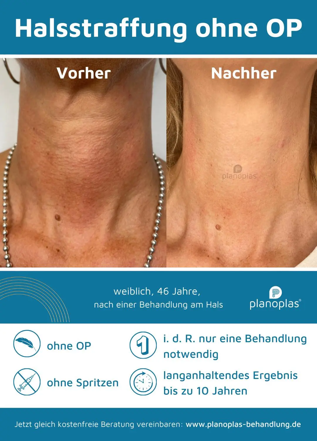 Ergebnis einer Plasma-Hautstraffung bei SmartBody Beauty in Leipzig – Bild 7 von 15