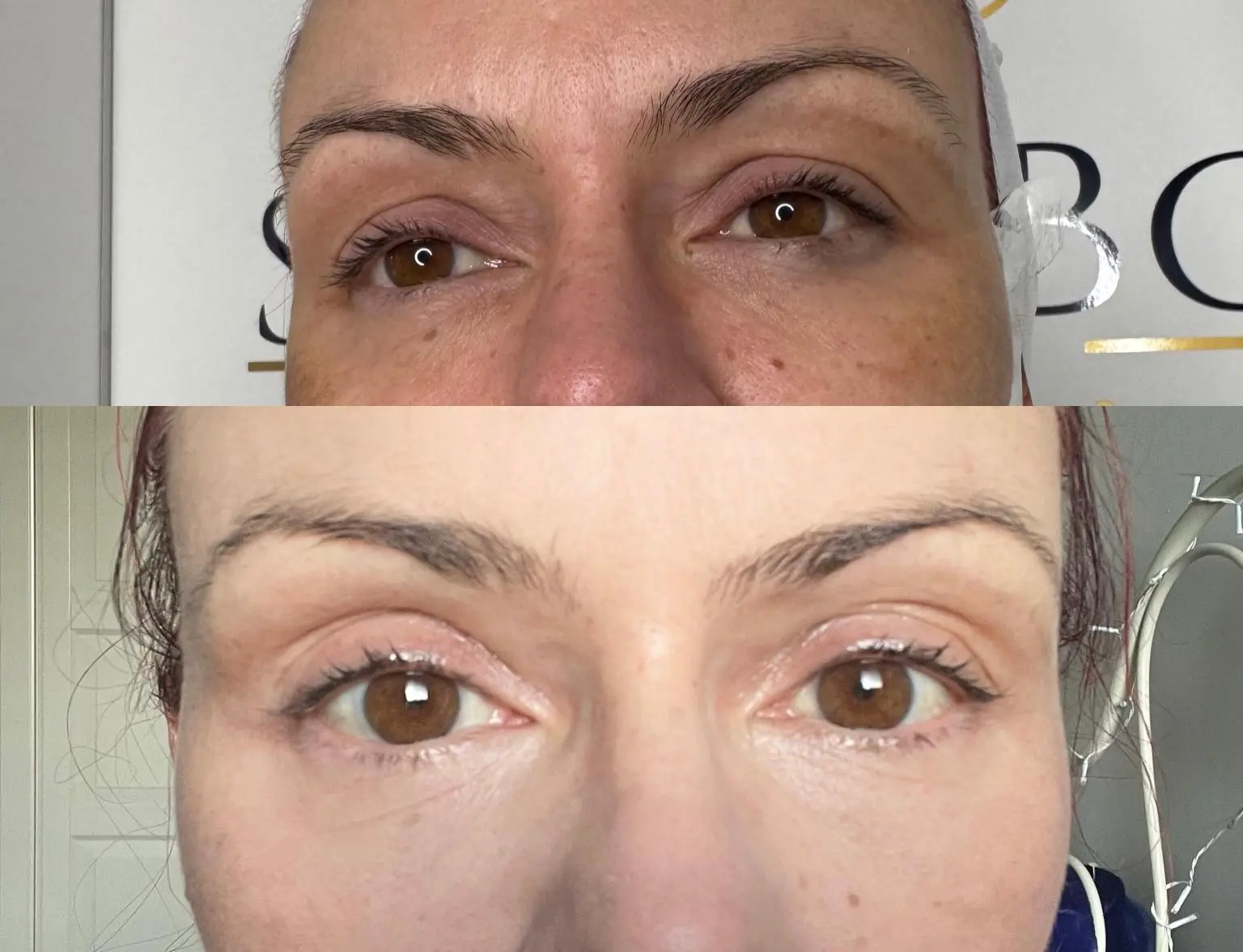 Ergebnis einer Plasma-Hautstraffung bei SmartBody Beauty in Leipzig – Bild 3